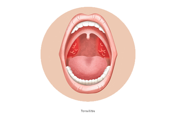 Types of Tonsillitis